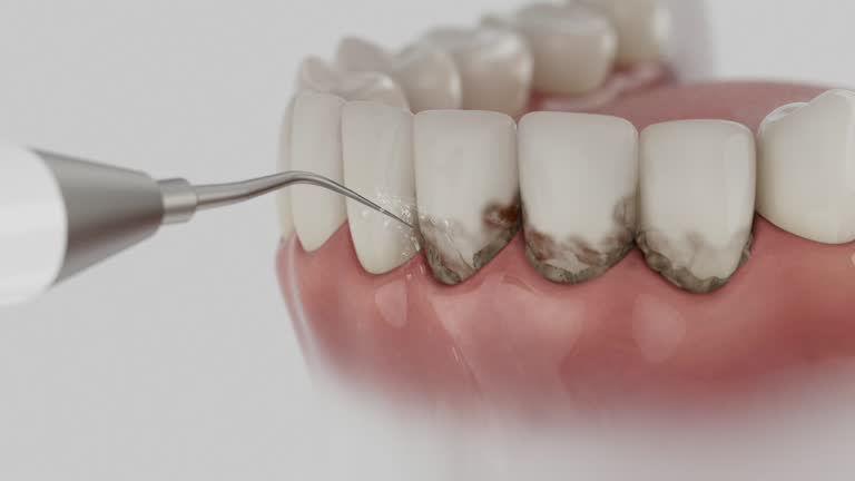 Trusted Dental Implants service in Miami Beach, FL - Dentist Open Now